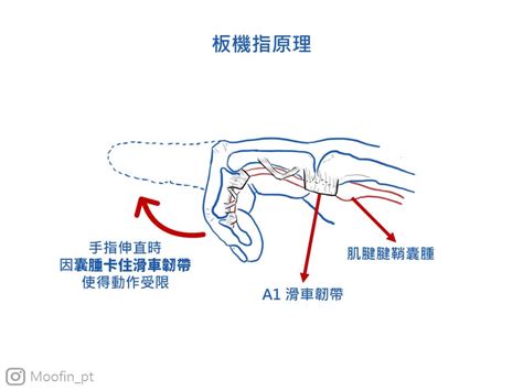 手指尾彎曲|手指彎曲就伸不直？板機指介紹：疾病成因、症狀、簡。